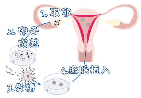 私人志愿者代孕服务怎么选